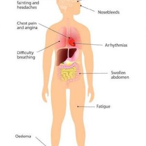 How To Identify The Symptoms Of High Blood Pressure