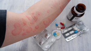 Read more about the article Alergi Obat Bisa Berbahaya: Ini Cara Mencegah dan Menghindarinya