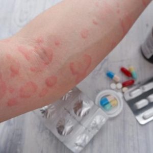 Alergi Obat Bisa Berbahaya: Ini Cara Mencegah dan Menghindarinya